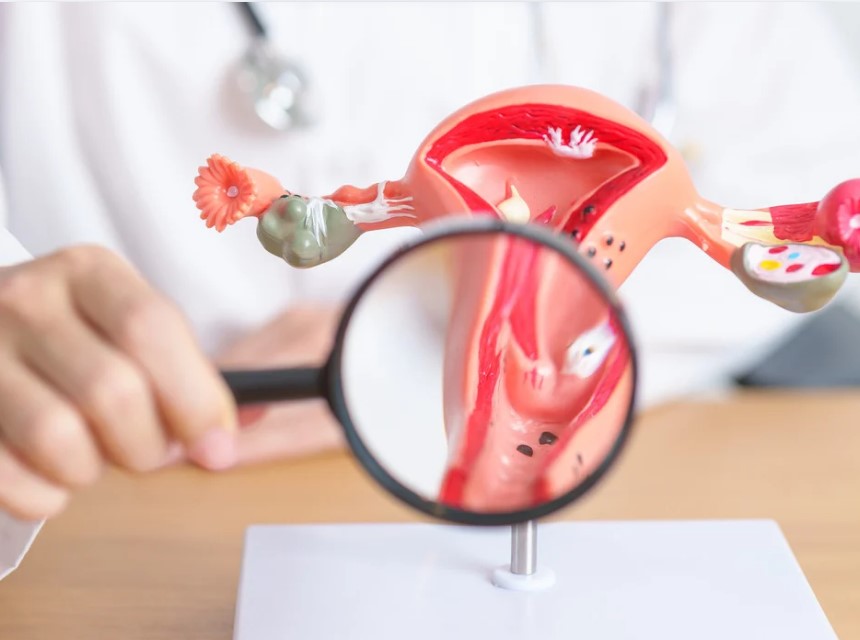 Buồng Trứng đa Nang Là Gì? Nguyên Nhân Từ Rối Loạn Nội Tiết đến Lối Sống Hiện đại